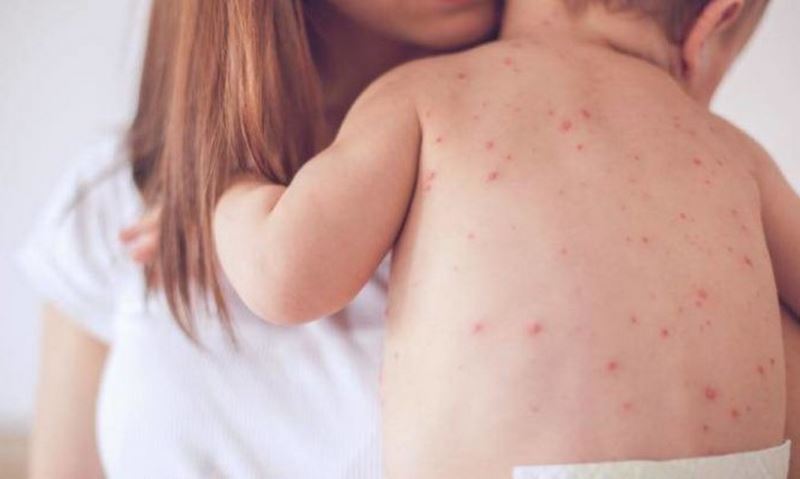 Η Διεύθυνση Δημόσιας Υγείας προειδοποιεί: “Αναγκαίος ο εμβολιασμός έναντι της ιλαράς”